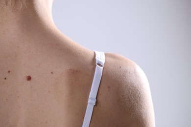 Photo of Woman with moles on her body against light background, closeup. Space for text