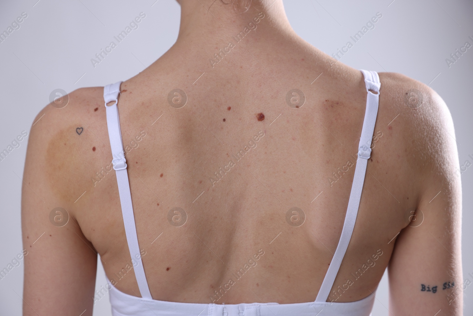 Woman with moles on her body against light background, closeup Photo of Woman with moles on her body against light background, closeup