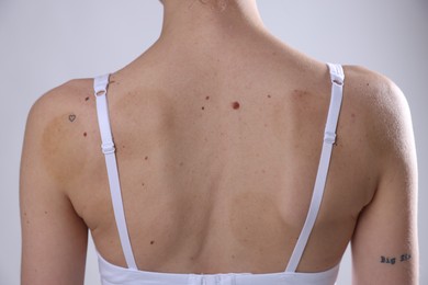 Photo of Woman with moles on her body against light background, closeup