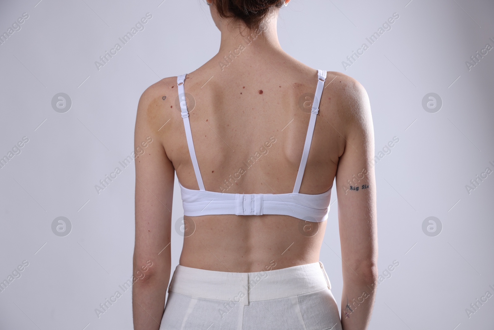 Photo of Woman with moles on her body against light background, closeup
