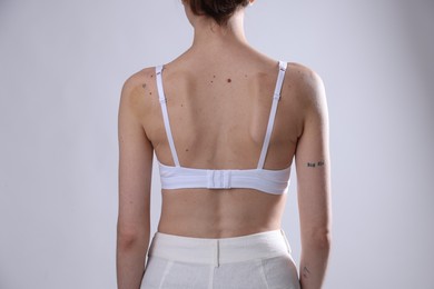 Photo of Woman with moles on her body against light background, closeup