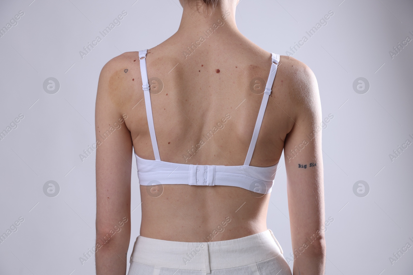 Photo of Woman with moles on her body against light background, closeup