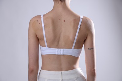 Photo of Woman with moles on her body against light background, closeup