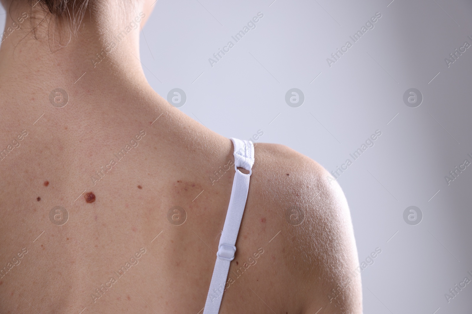 Woman with moles on her body against light background, closeup. Space for text Photo of Woman with moles on her body against light background, closeup. Space for text