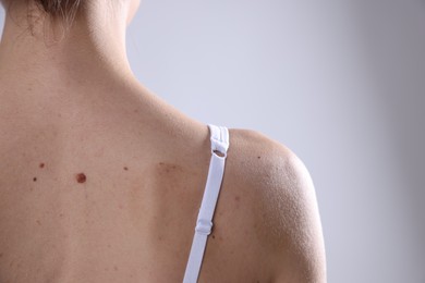 Photo of Woman with moles on her body against light background, closeup. Space for text
