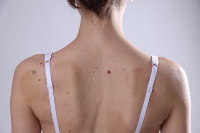 Photo of Woman with moles on her body against light background, closeup