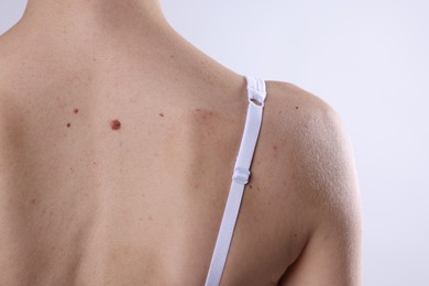 Photo of Woman with moles on her body against light background, closeup