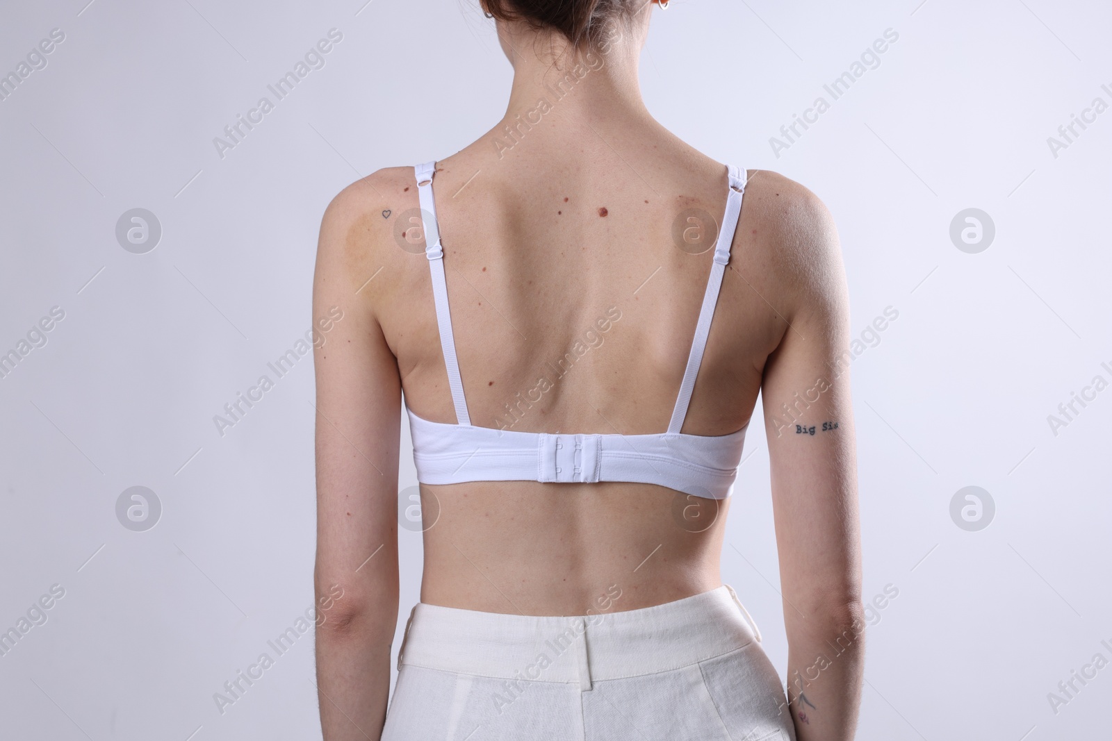 Photo of Woman with moles on her body against light background, closeup