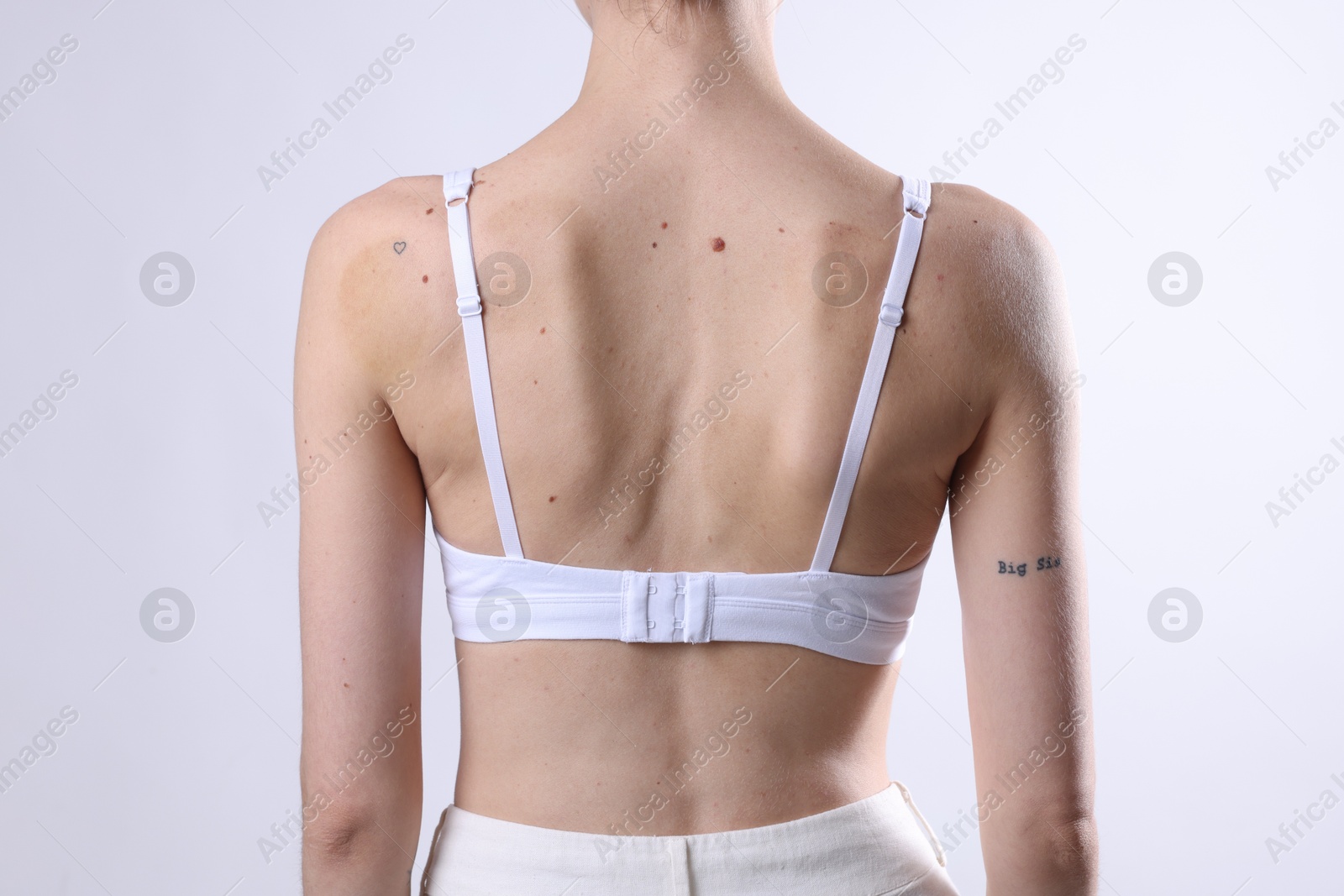 Photo of Woman with moles on her body against light background, closeup
