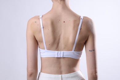 Photo of Woman with moles on her body against light background, closeup