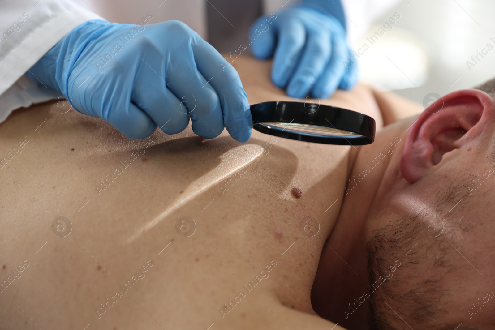 Doctor examining man's moles in hospital, closeup Photo of Doctor examining man's moles in hospital, closeup