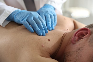 Photo of Doctor examining man's moles in hospital, closeup