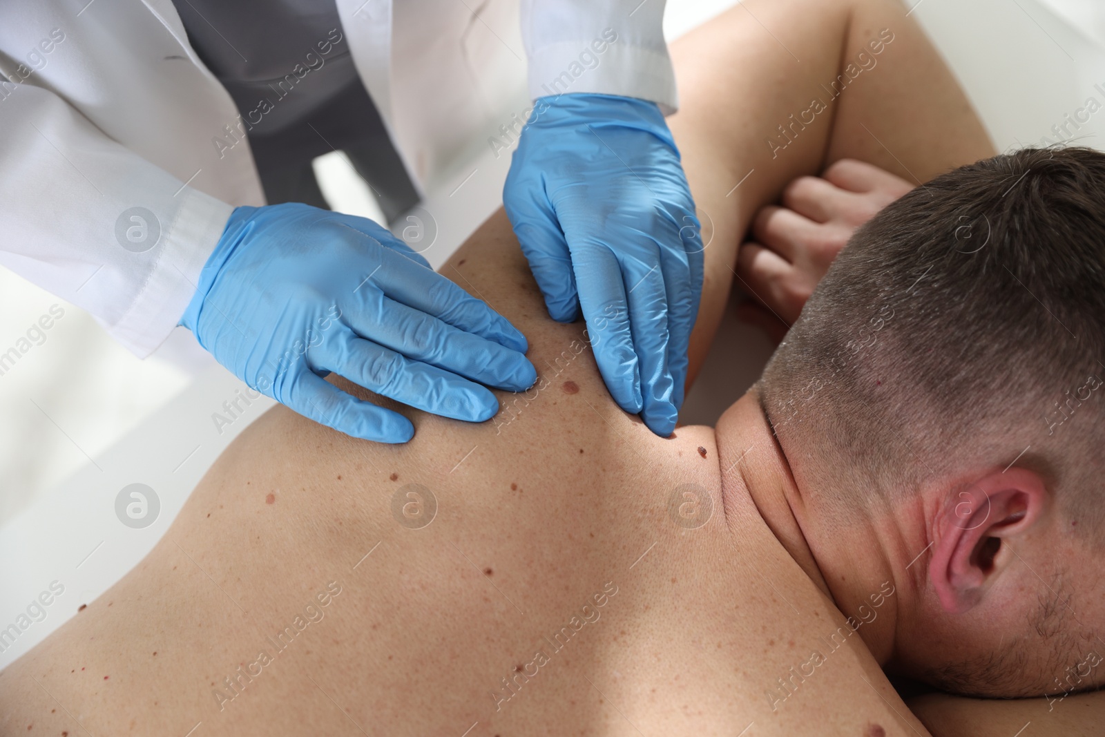 Photo of Doctor examining man's moles in hospital, closeup