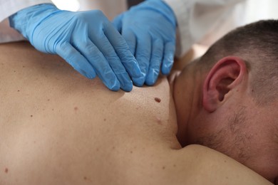 Photo of Doctor examining man's moles in hospital, closeup
