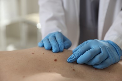 Photo of Doctor examining man's moles in hospital, closeup