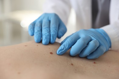 Photo of Doctor examining man's moles in hospital, closeup