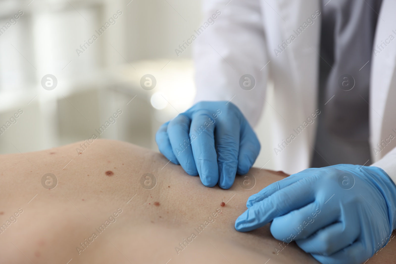 Doctor examining man's moles in hospital, closeup Photo of Doctor examining man's moles in hospital, closeup