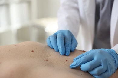 Photo of Doctor examining man's moles in hospital, closeup