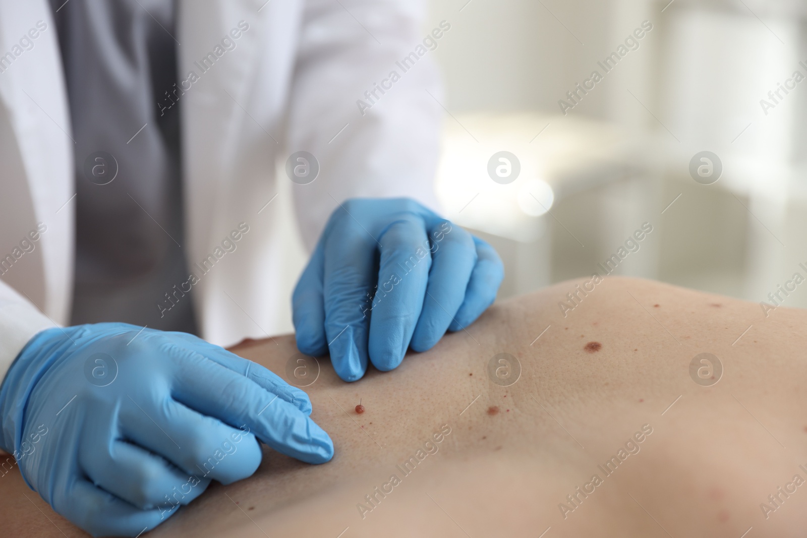 Doctor examining man's moles in hospital, closeup Photo of Doctor examining man's moles in hospital, closeup