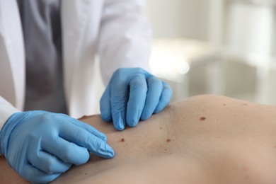 Photo of Doctor examining man's moles in hospital, closeup