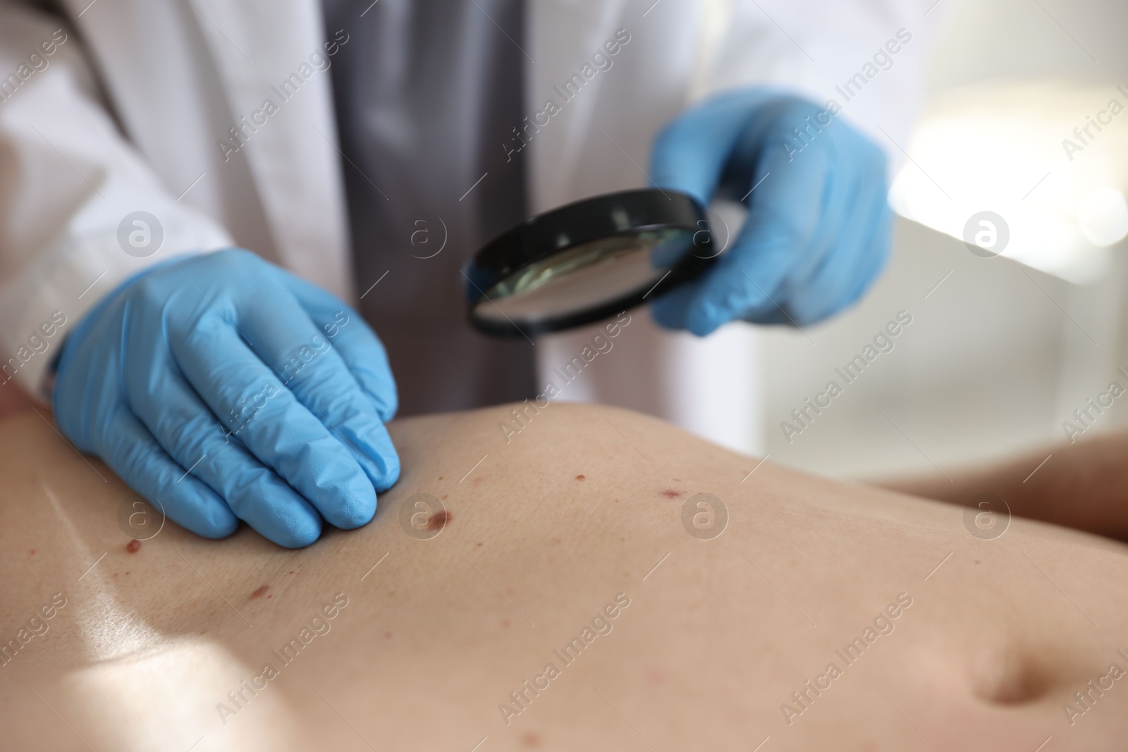 Doctor examining man's moles in hospital, closeup Photo of Doctor examining man's moles in hospital, closeup