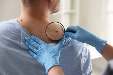 Photo of Doctor examining man's moles in hospital, closeup