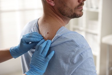 Photo of Doctor examining man's moles in hospital, closeup