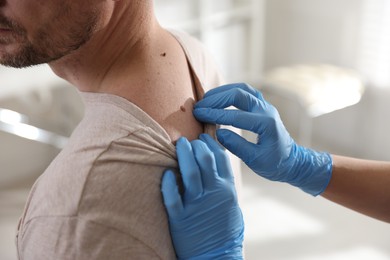 Photo of Doctor examining man's moles in hospital, closeup