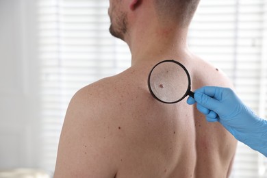 Photo of Doctor examining man's moles in hospital, closeup