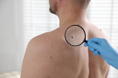 Photo of Doctor examining man's moles in hospital, closeup