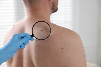 Photo of Doctor examining man's moles in hospital, closeup