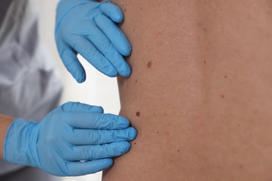 Photo of Doctor examining man's moles in hospital, closeup