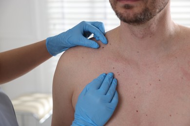 Photo of Doctor examining man's moles in hospital, closeup