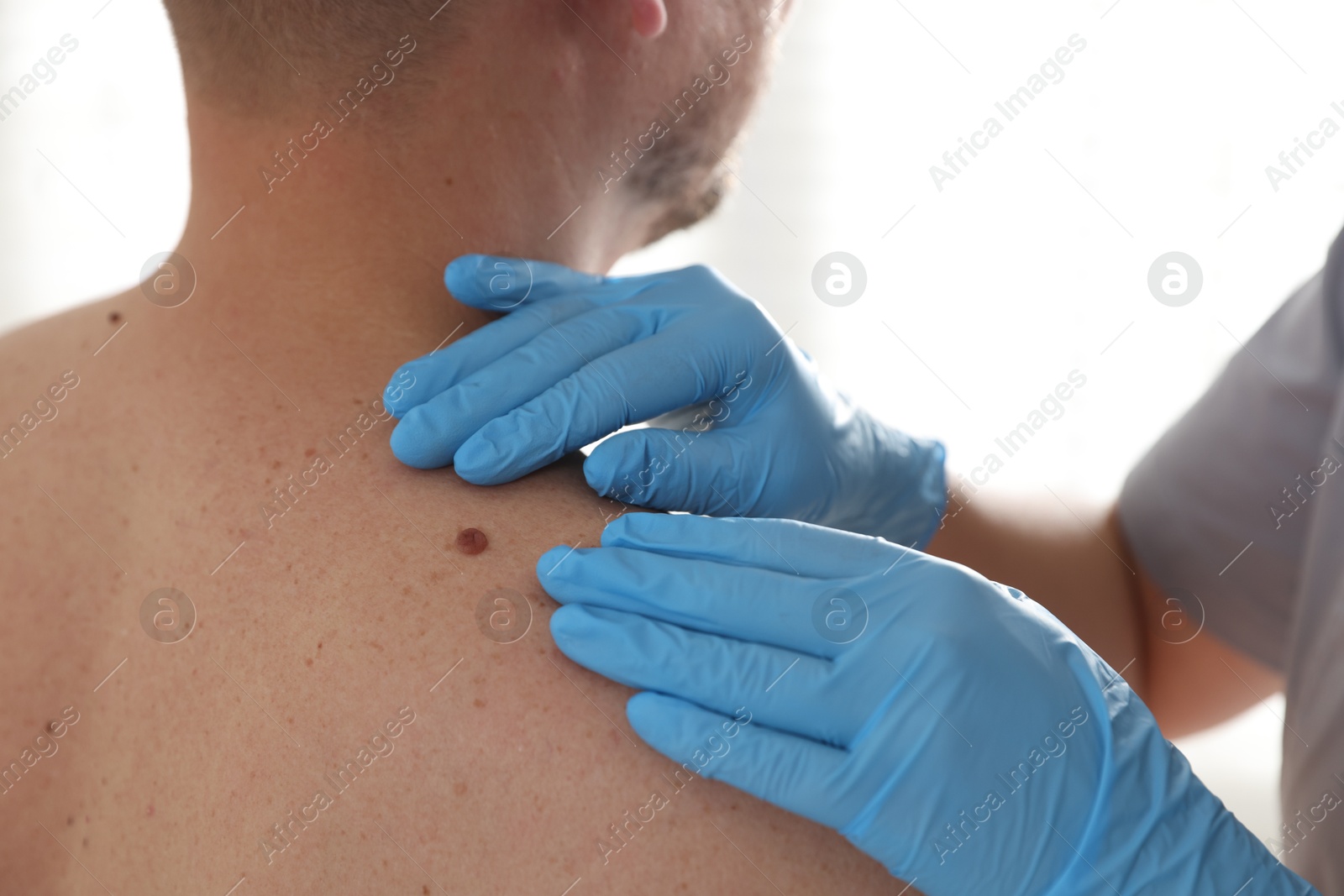 Photo of Doctor examining man's moles in hospital, closeup
