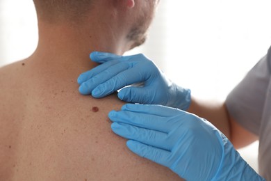 Photo of Doctor examining man's moles in hospital, closeup