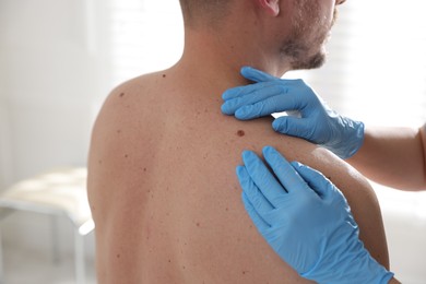 Photo of Doctor examining man's moles in hospital, closeup