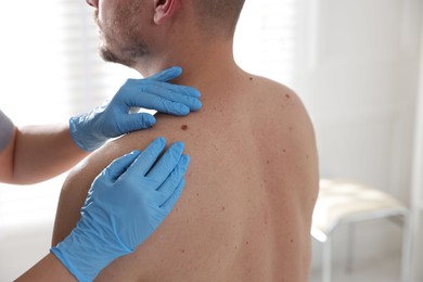Photo of Doctor examining man's moles in hospital, closeup