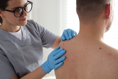 Photo of Doctor examining man's moles in hospital, closeup