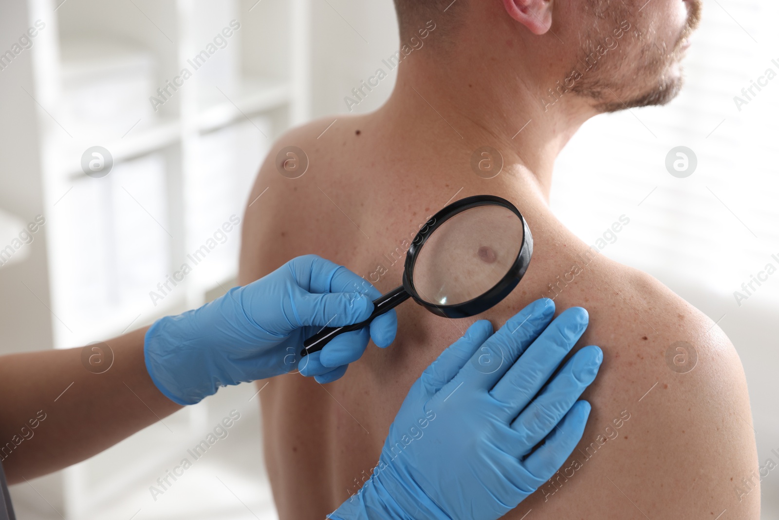 Photo of Doctor examining man's moles in hospital, closeup