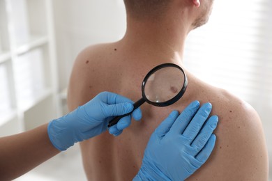 Photo of Doctor examining man's moles in hospital, closeup