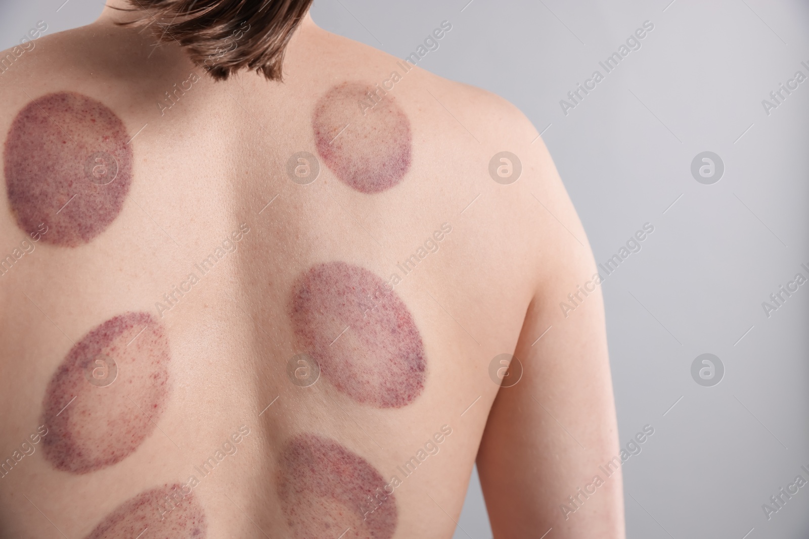 Woman after cupping therapy on gray background, closeup Photo of Woman after cupping therapy on gray background, closeup