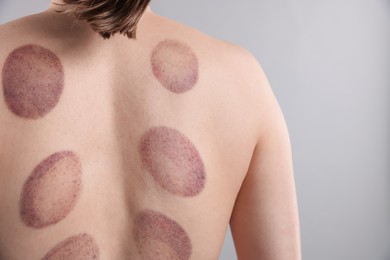 Photo of Woman after cupping therapy on gray background, closeup