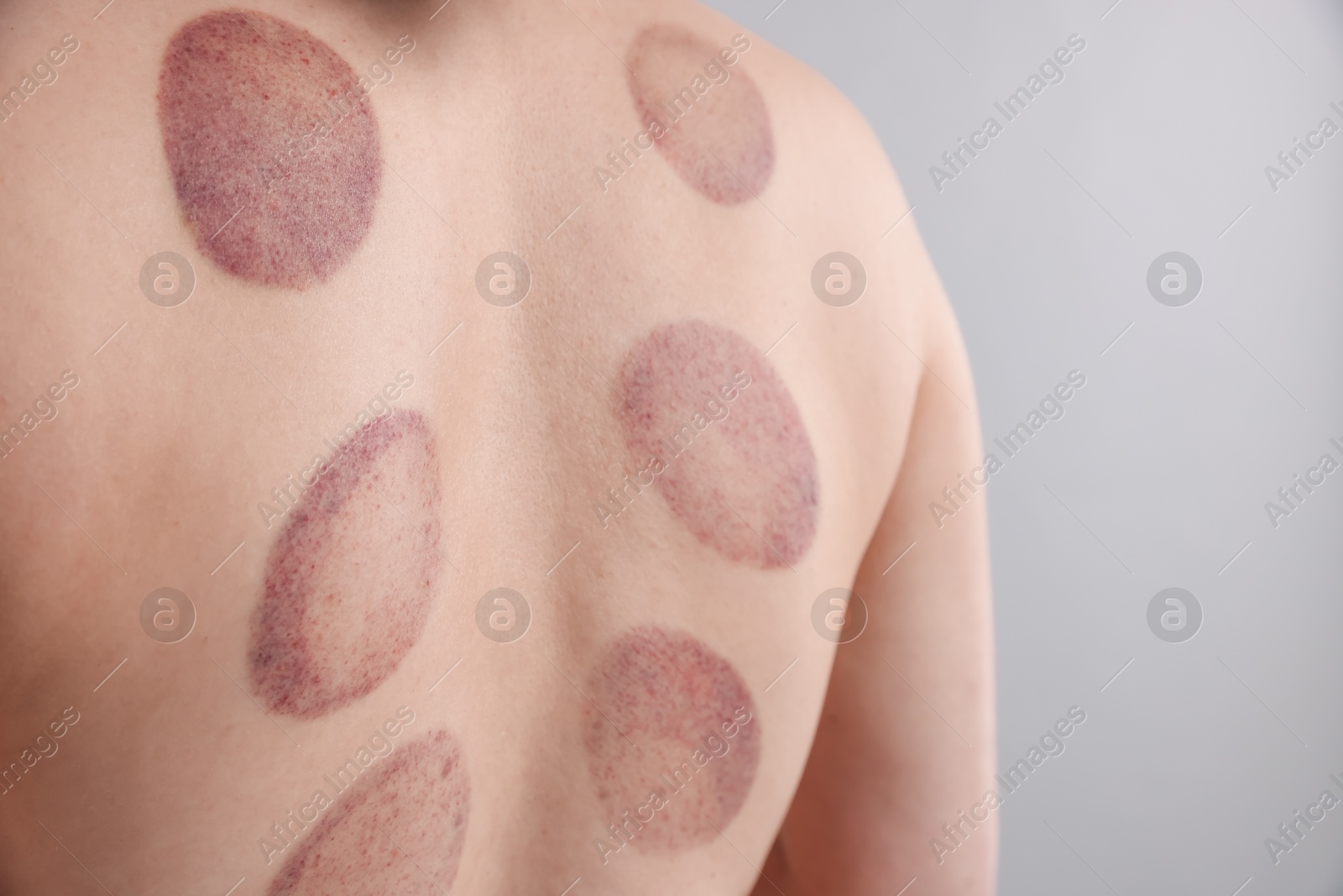 Woman after cupping therapy on gray background, closeup Photo of Woman after cupping therapy on gray background, closeup