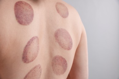 Photo of Woman after cupping therapy on gray background, closeup