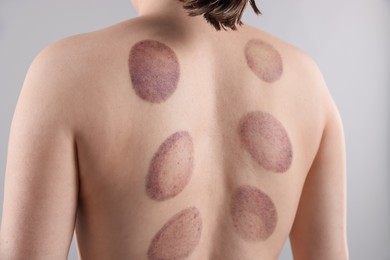 Photo of Woman after cupping therapy on gray background, closeup