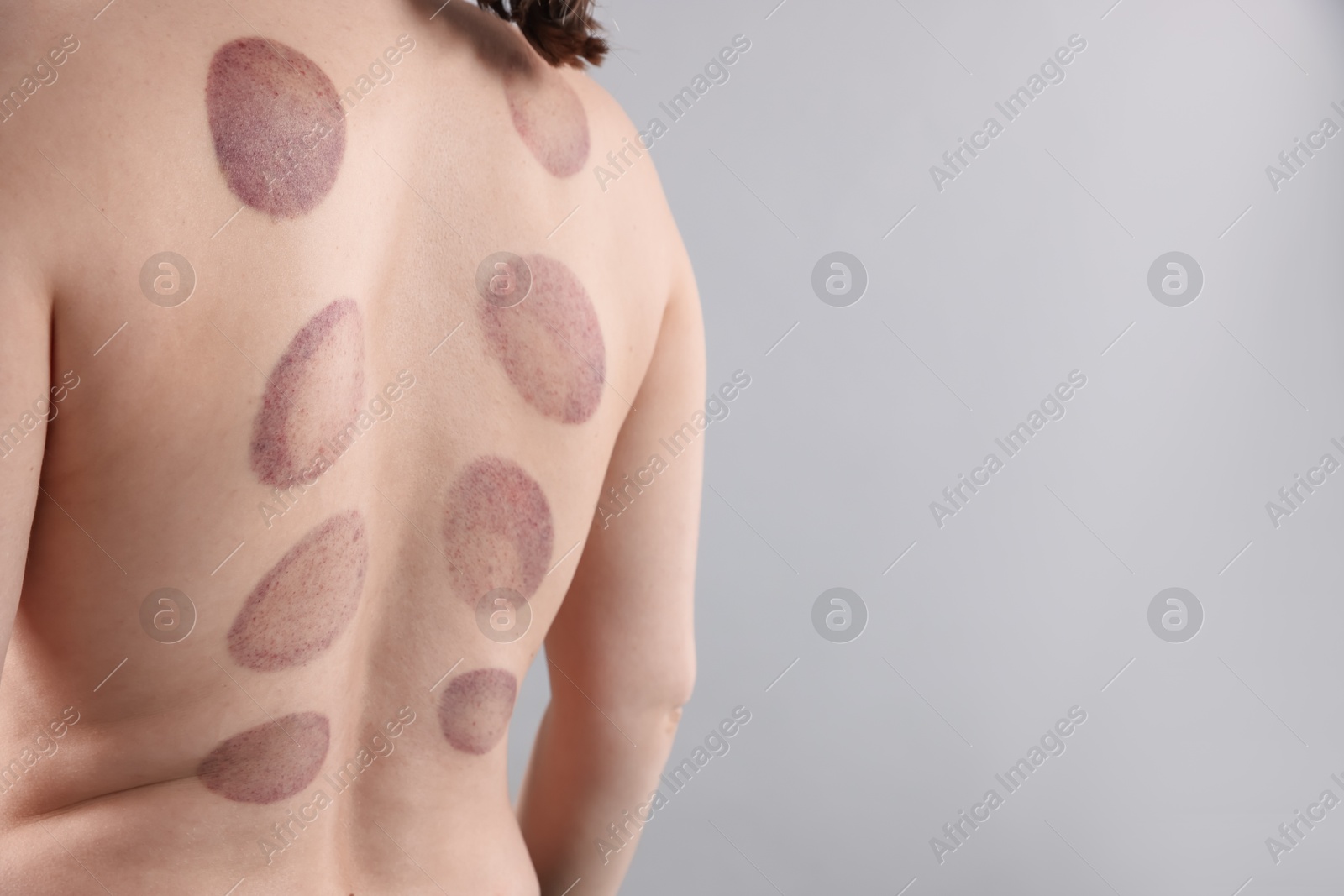 Woman after cupping therapy on gray background, closeup. Space for text Photo of Woman after cupping therapy on gray background, closeup. Space for text