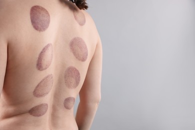 Photo of Woman after cupping therapy on gray background, closeup. Space for text