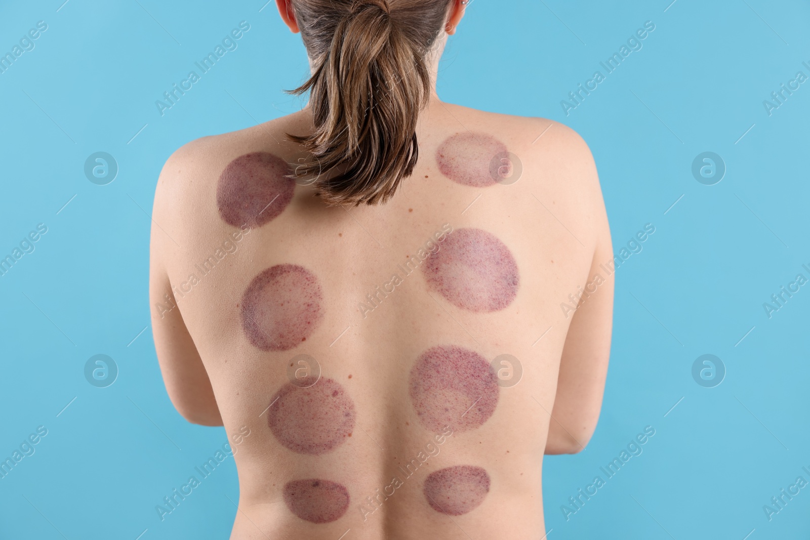 Woman after cupping therapy on light blue background, closeup Photo of Woman after cupping therapy on light blue background, closeup
