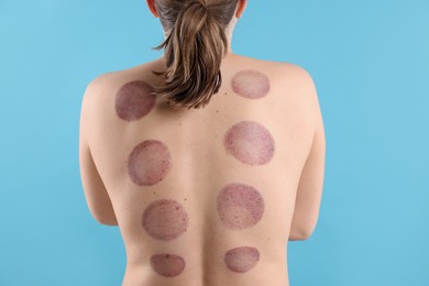 Photo of Woman after cupping therapy on light blue background, closeup