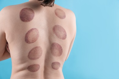Photo of Woman after cupping therapy on light blue background, closeup. Space for text